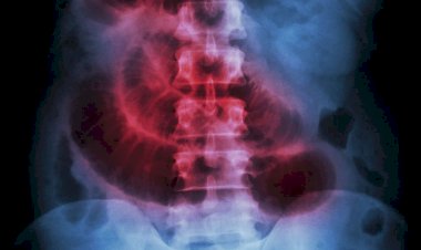 Bolsonaro internado de novo: o que é obstrução intestinal?
